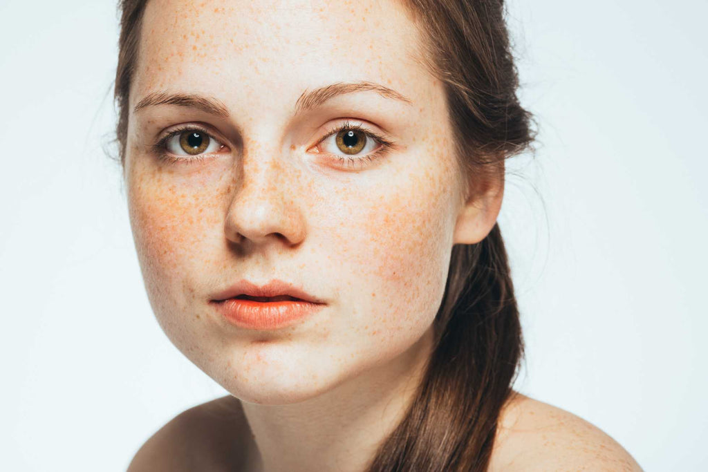 Know All About Hyperpigmentation: Types, Causes & Treatment