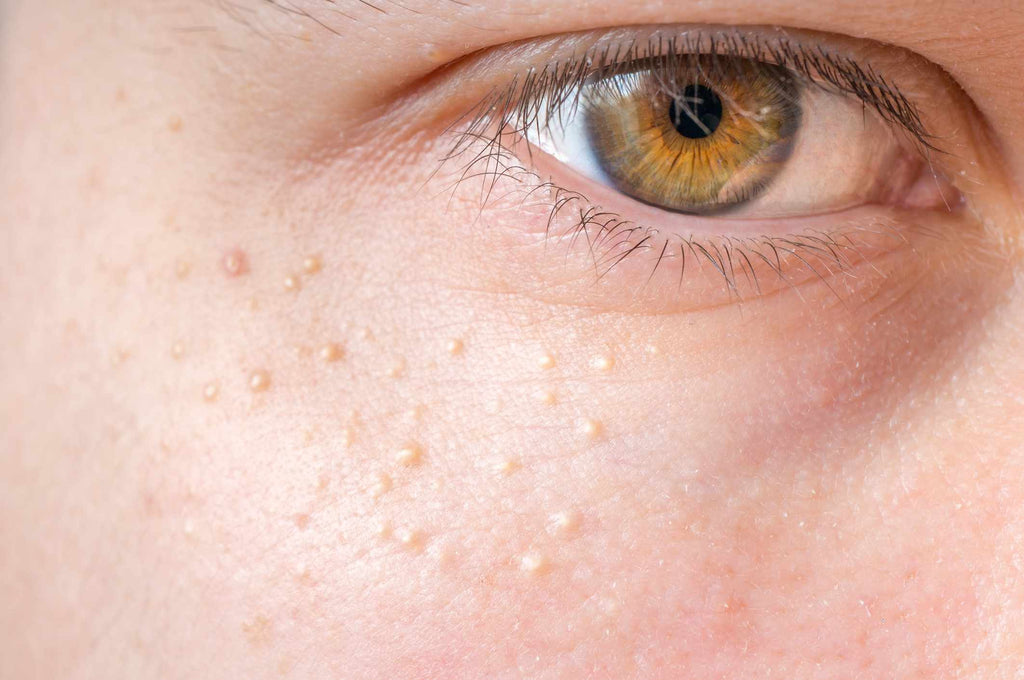 Tiny Bumps On Your Face? Here's How To Get Rid Of Them